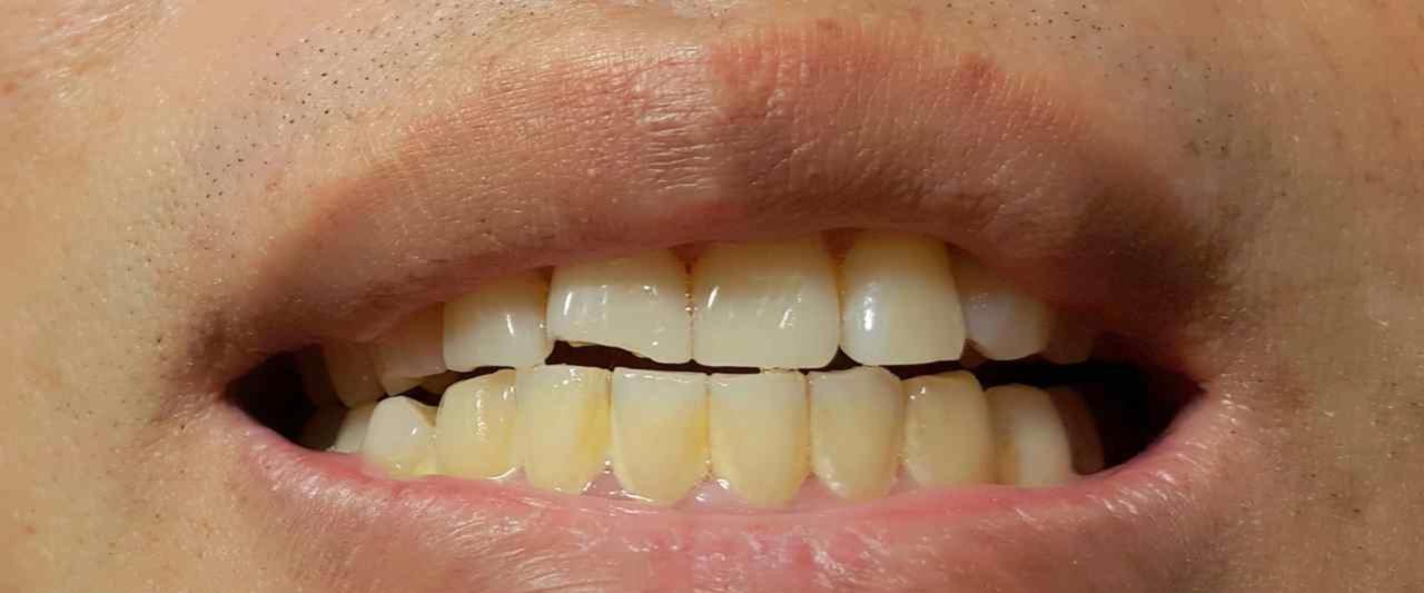 How much does it cost to fix a chipped crown