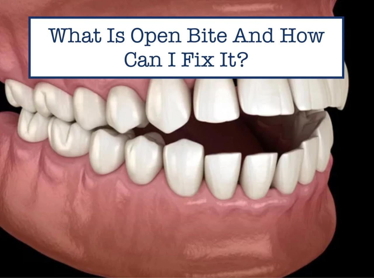 How to fix open bite naturally
