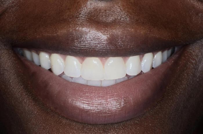 How to fix gap between crown and gum
