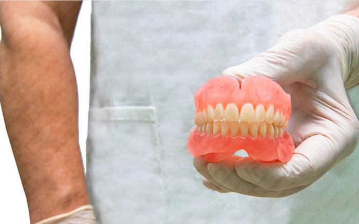 Implants How to clean all on 4 dental implants