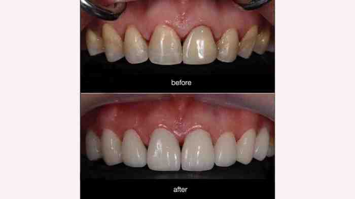 How long does it take to get a veneer