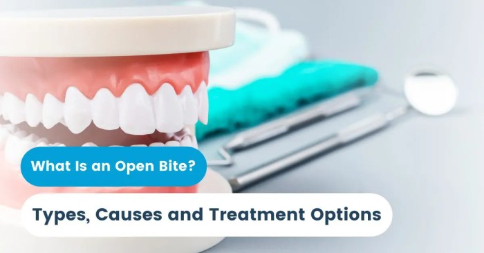 How to fix open bite naturally