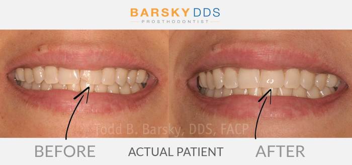 Tooth chipped fix broken teeth bonding can Tooth chipped fix broken teeth bonding can