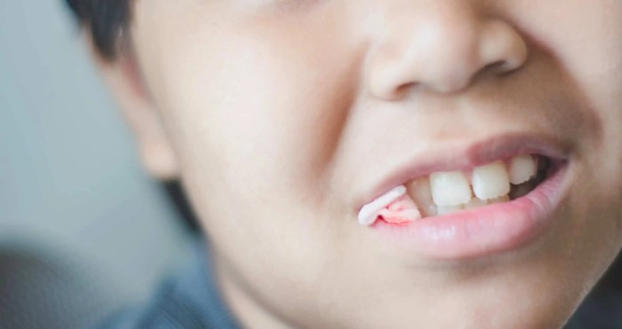 Gauze extraction toothache remedies bleeding heal dentaly teabag Gauze extraction toothache remedies bleeding heal dentaly teabag