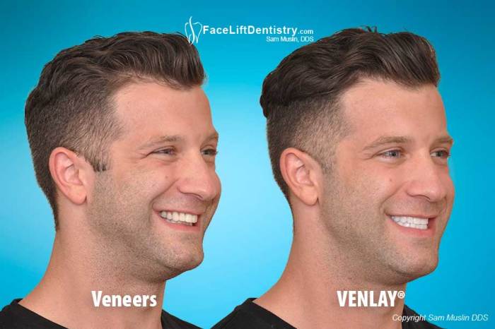 How to fix an overbite without braces