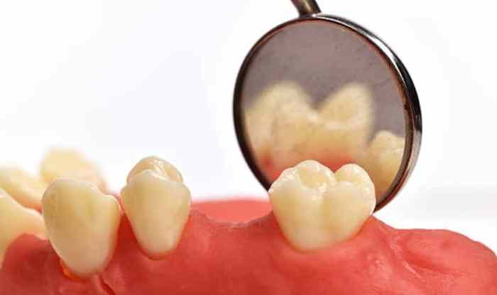 How to fix gap between crown and gum