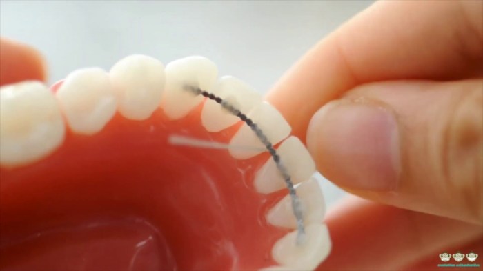How to floss with a permanent retainer